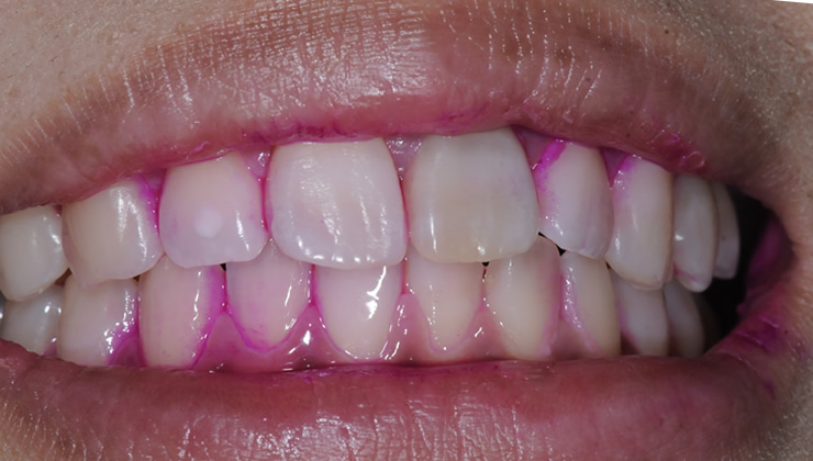 3DS口腔内除菌法の治療後