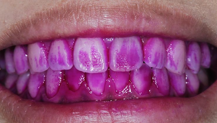 3DS口腔内除菌法の治療前