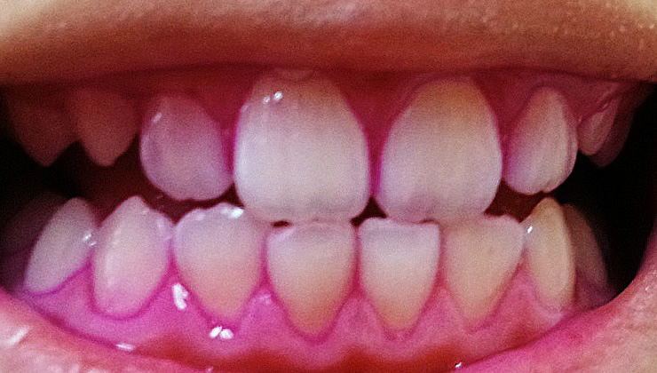 3DS口腔内除菌法の治療後