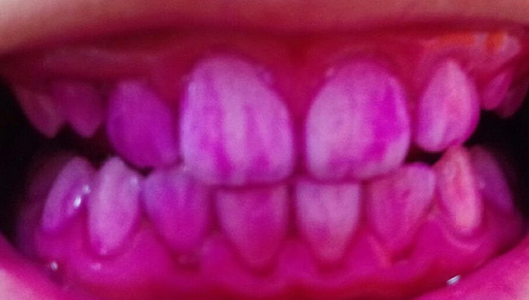 3DS口腔内除菌法の治療前