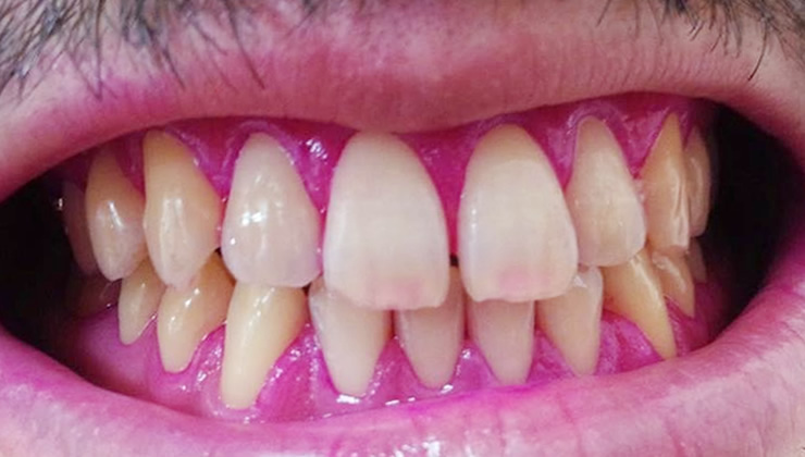 3DS口腔内除菌法の治療後