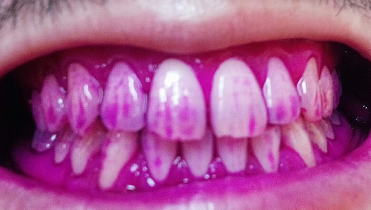 3DS口腔内除菌法の治療前