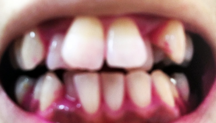 3DS口腔内除菌法の治療後