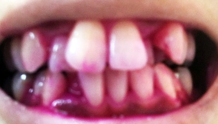 3DS口腔内除菌法の治療前