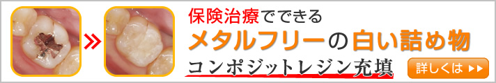 保険治療でできるメタルフリーの白い詰め物｜コンポジットレジン充填