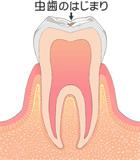 初期の虫歯