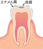 エナメル質の虫歯