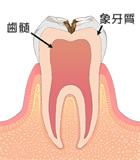 象牙質の虫歯