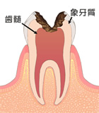 神経の虫歯