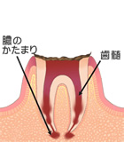 末期の虫歯