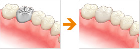 オールセラミックスクラウンのイメージ画像