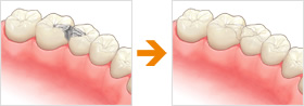 オールセラミックインレーのイメージ画像