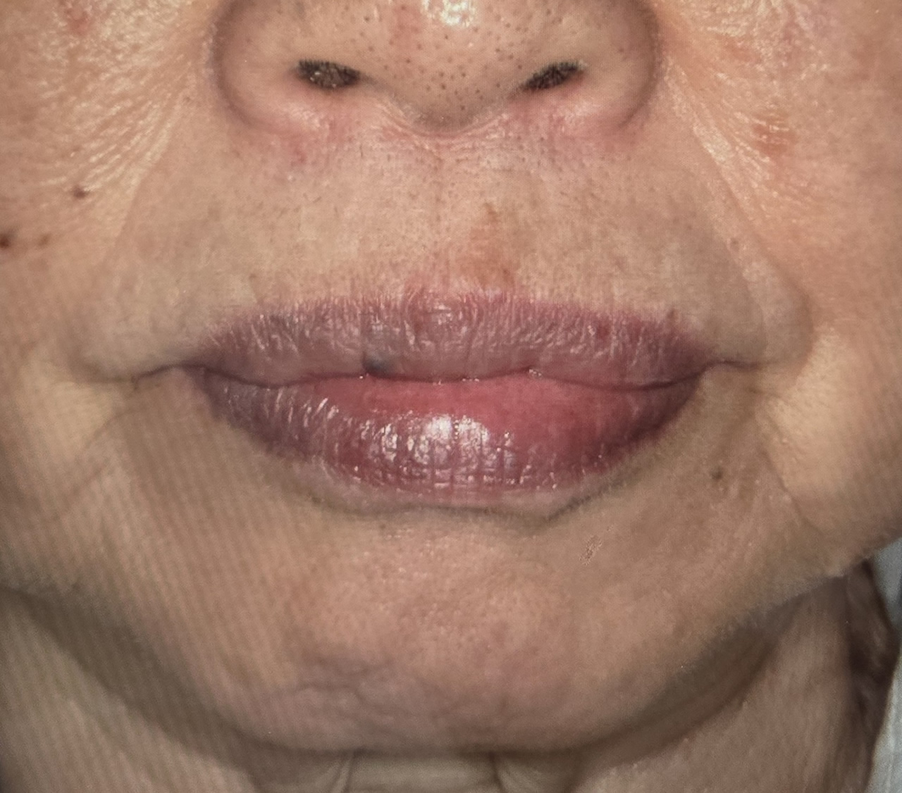 適正な噛み合わせの義歯を装着した顔