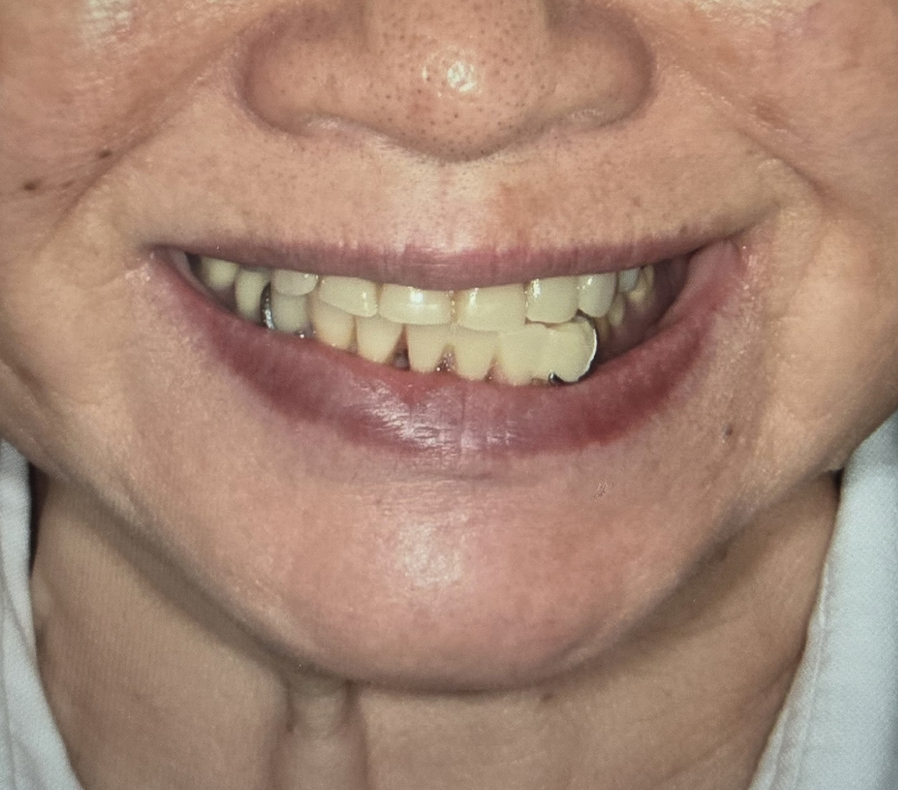 噛み合わせが低い不適合義歯を装着した顔