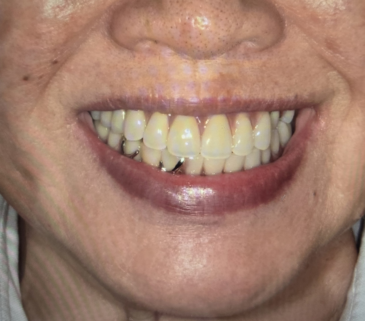 適正な噛み合わせの義歯を装着した顔